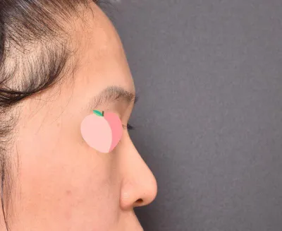 Very Good гоо сайхны эмнэлгийн Им Ён Мин эмчээр хамрын хагалгаа хийлгэсэн