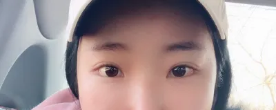 Нүдний доод булан нээх дахин хагалгаа хийлгэсэн ㅎㅎ