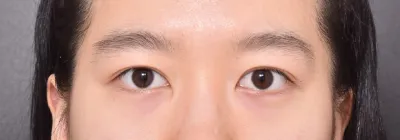 Нүдний дахин хагалгаа амжилттай боллоо ㅠㅠ