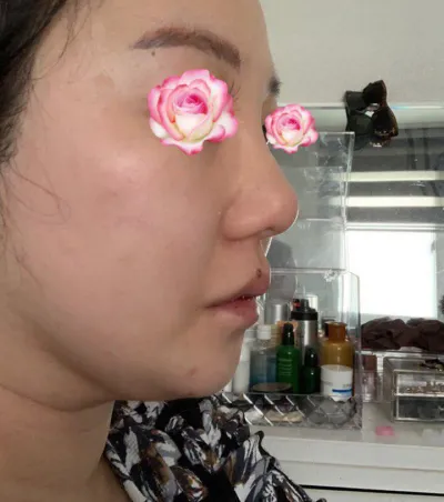 "Very Good" гоо сайхны эмнэлэгт хамрын хагалгаа хийлгэлээ.