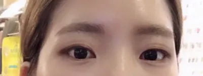 Зүсэлттэй давхраа хийлгээд 5-6 долоо хоног болж буй сэтгэгдэлㅋㅋㅋ