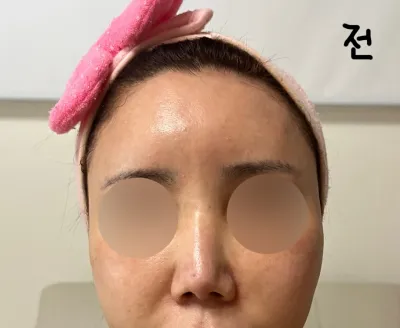 Богино хамар засах хагалгааны сэтгэгдэл