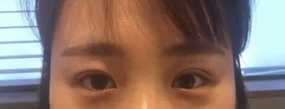 Нүдний мэс заслын дараах 12 дахь өдрийн сэтгэгдэл~