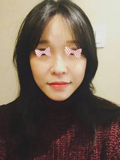 Нүүрний өөх шилжүүлэн суулгах хагалгаа!