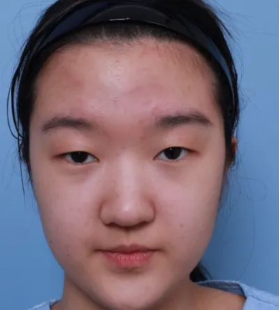 Нүдний хагалгааны 7 дахь өдөр