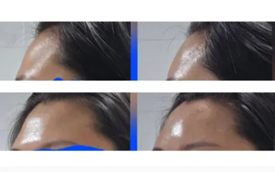 [Ч** үйлчлүүлэгч] Духны филлерийн сэтгэгдэл