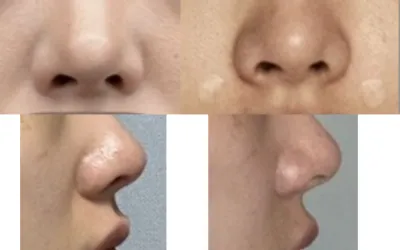 [** үйлчлүүлэгч] Хамар уруулын филлерийн сэтгэгдэл