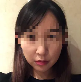 Лифтинг хагалгааны сэтгэгдэл