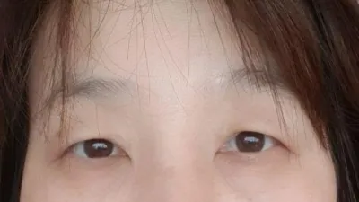 Нүдний хагалгааны сэтгэгдэл