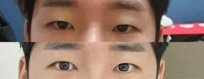 Нүдний хагалгааны сэтгэгдэл