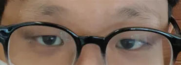 Нүдний хагалгааны сэтгэгдэл