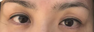 Нүдний хагалгааны сэтгэгдэл