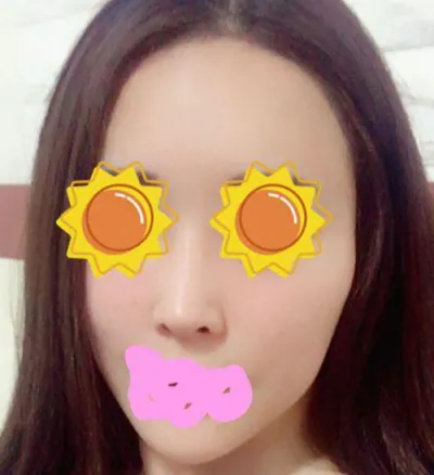 Нүүрний хэлбэр засах | Бусад хагалгааны сэтгэгдэл