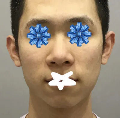 Хамар | Нүүрний хэлбэр засах хагалгааны сэтгэгдэл