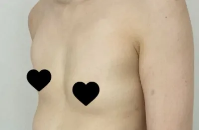 Хөхний хагалгааны сэтгэгдэл.