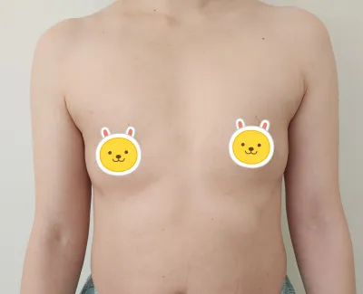 [Давтан хагалгаа] Хөх томруулах хагалгааны 1 долоо хоногийн дараах сэтгэгдэл!