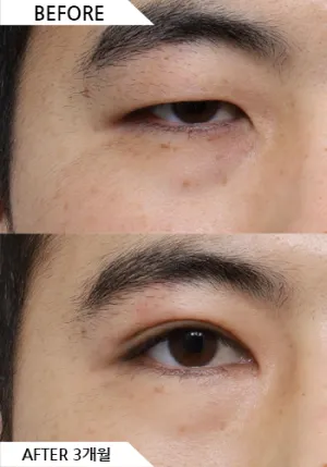 Before
