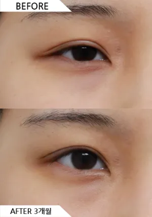 Before