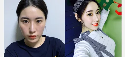 Нүүрний хэлбэр засах мэс засал