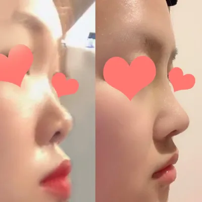 Хамрын мэс заслын дараах сэтгэгдэл!!