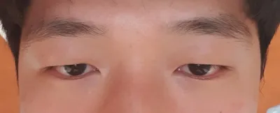 Зүсэлттэй нүдний хэлбэр засах