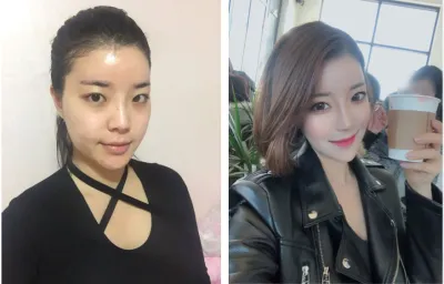 Би Жэйжүнд нүүрний хэлбэр засах 4 төрлийн хагалгаа хийлгэсэн