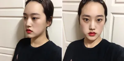 Дөрвөлжин эрүү багасгах, урд эрүү, кортикал ясны тайралт, хамрын хагалгааг ийнхүү хийлгэсэн! ==== 3333