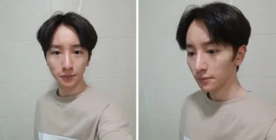 Нүүрний хэлбэр засах, Хамрын мэс засал, Бүрэн нүүрний өөх шилжүүлэн суулгах