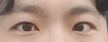 Эрэгтэй хүний нүдний хэлбэр засах мэс засал (өмнөд хэсгийг оруулаад, зүсэлт)