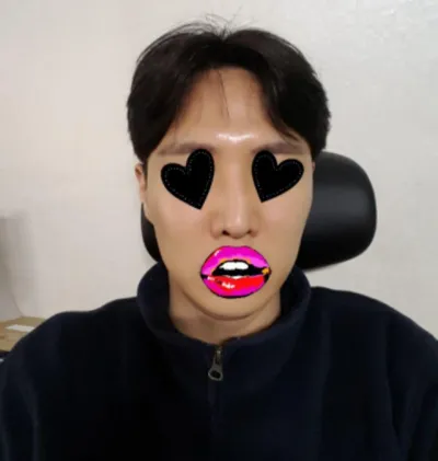 Дурангийн хөмсөг өргөх (эндотин), Хамрын дахин мэс засал (хамрын гол, үзүүр), Муруй хамар засах, Хамрын нүх багасгах