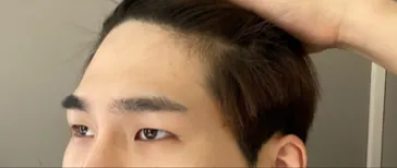 Нүдний хэлбэр засах болон дух өргөх мэс засал хийлгэсний дараах 5 сарын тойм!