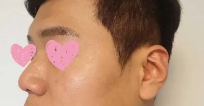 Хамрын нуруу, үзүүр, том хамар засах, бөгтөр хамар