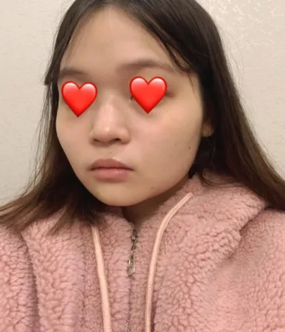 Нүүрний хэлбэр засах + хамрын мэс засал хийлгэснээс хойш 3 сар гаруй болжээ!