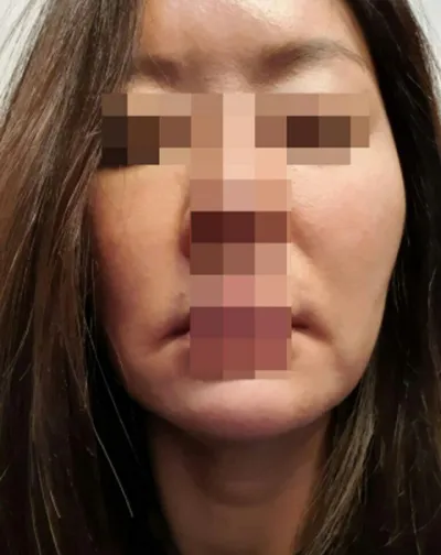 Нүдний доорхи өөх шилжүүлэн суулгах, нүүр өргөх