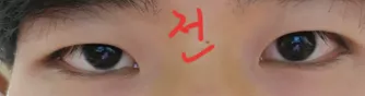 #Жэйжүний нүдний хэлбэр засах мэс заслын дараах сэтгэгдэл