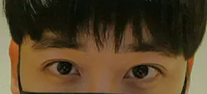 Давхар зовхи (зүсэлт), Нүдний хэлбэр засах, Шугамыг намсгах