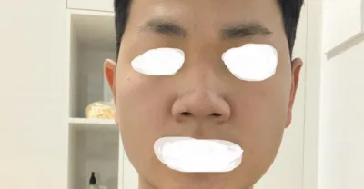 Сайн байна уу? Хамрын мэс засал хийлгэснээс хойш 1 долоо хоног болж байна.