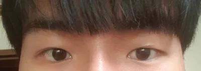 Хэсэгчилсэн зүслэгтэй зовхи заслын дахин хагалгаа