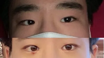 Давхар зовхи (булагдсан), урд зүсэлт