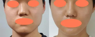 Дөрвөлжин эрүү, кортикал остеоэктоми, зажлах булчингийн агшилт