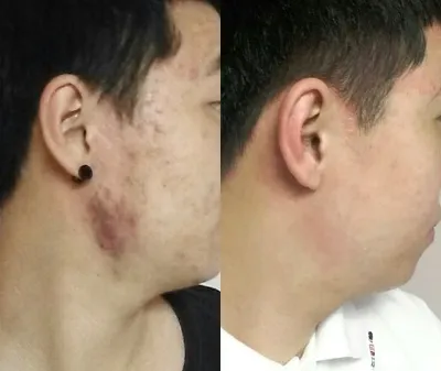 Батга эмчилгээний 6 сарын дараах сэтгэгдэл