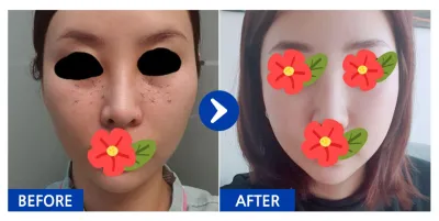 [Бабиток] Нүүрний хэлбэр засах, Нүдний доорх өөх дахин хуваарилах / 2 дахь сар / Ник нэр: 얌얌얌얌123