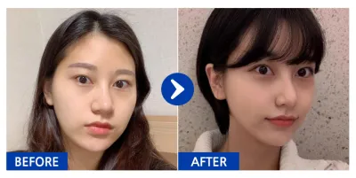 [Babytalk] Нүүрний хэлбэр засах, өөх шилжүүлэн суулгах / 6 дахь сар / Ник нэр: 아멜리칼노