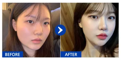 [Babytalk] Нүүрний хэлбэр засах, давхраа, хамрын мэс засал / 7 дахь сар / Ник нэр: 설윤2