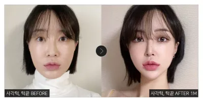 [Gangnam Unni сэтгэгдэл] Дөрвөлжин эрүү, эрүүний үзүүр засах мэс засал хийлгээд 1 сар болж байна / Никнейм: 곰돌이삼형제