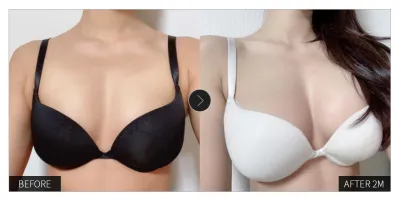 [Gangnam Unni сэтгэгдэл] Хөхний мэс засал хийлгээд 2 сар болж байна / Никнейм: 우우우나а