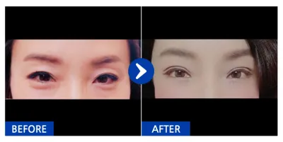 [Gangnam Unni] Дээд, доод зовхины мэс засал / 1 дэх сар / Ник нэр: JONABI555