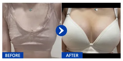 [Babytalk] Хөхний мэс засал (Sebbin Martex) / 5 дахь сар / Ник нэр: 횬니횬니야