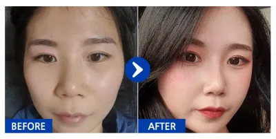 [Бабиток] Хамрын мэс засал / 2 дахь сар / Никнэйм : 닉넴11111