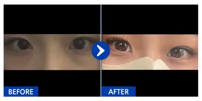 [Бабиток] Нүдний доод хэсэг, Давхраа (Оёдолгүй) / 2 дахь сар / Никнэйм : 언이어니언디